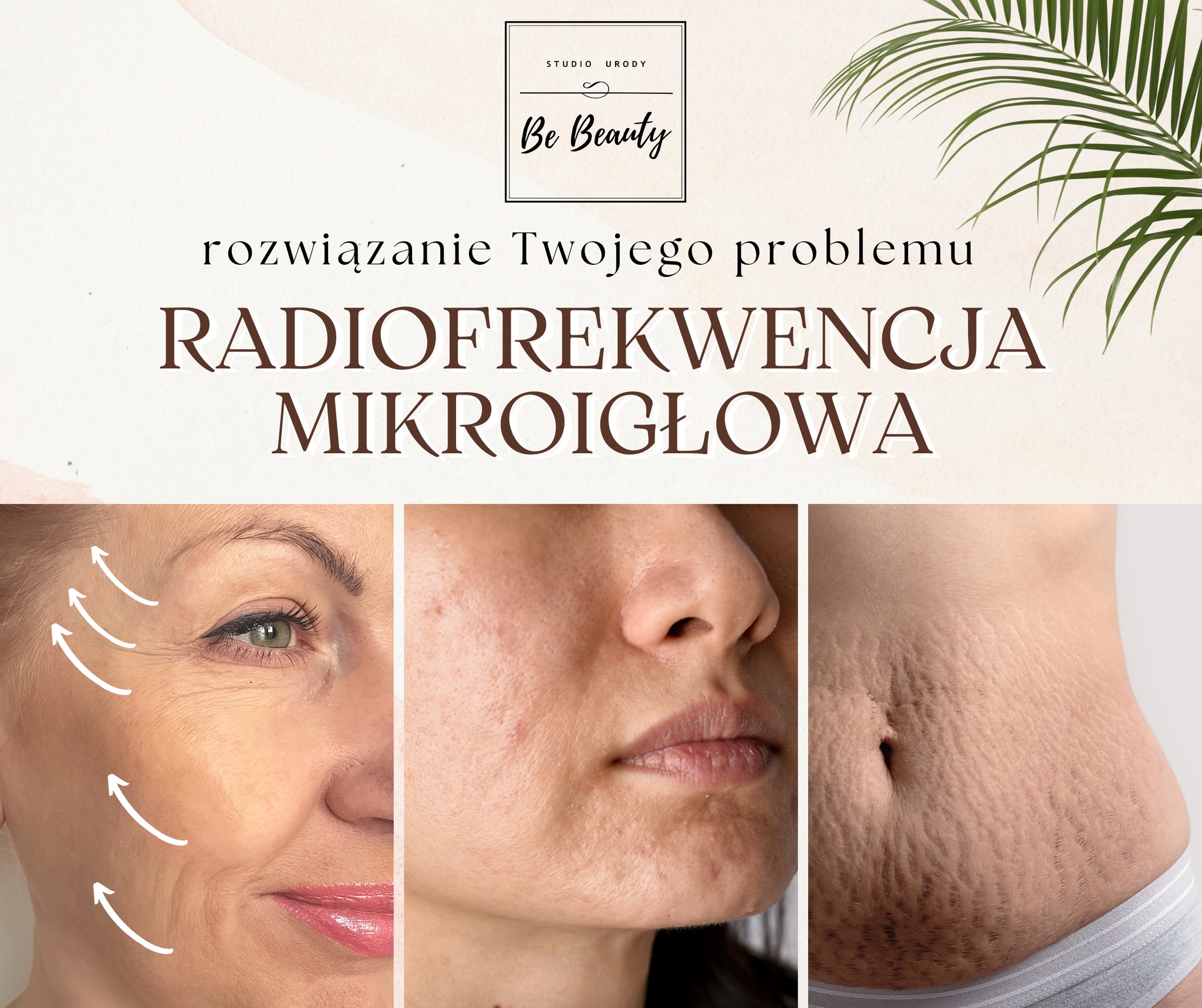 Read more about the article Radiofrekwencja Mikroigłowa